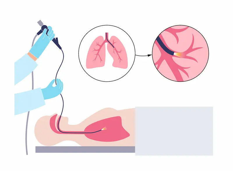 Guide to Endobronchial Ultrasound Ebus